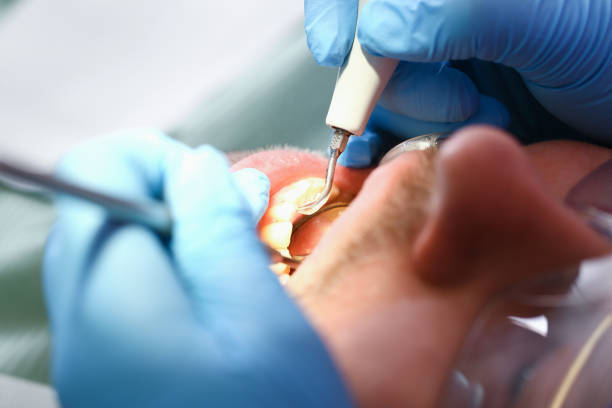 Best Emergency Root Canal Treatment in Beale Af, CA
